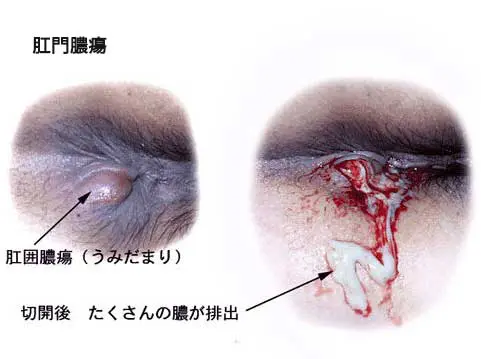 肛門科｜お尻から出血・肛門の出っ張り、痛み、かゆみ｜三重津駅前つじうら胃腸肛門内視鏡クリニック