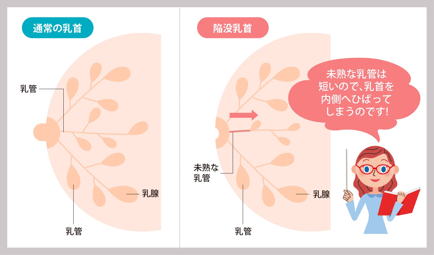 男性の大きい乳首を確実に浮かない、透けないようにする唯一の方法 | 男性用乳頭縮小術