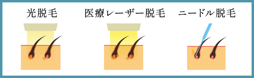 毛を抜く」自己処理はNG！脱毛中にムダ毛をなくす正しい処理方法 | メンズ脱毛百科事典 リンクスペディア