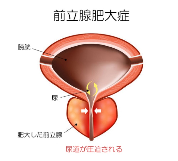 前立腺マッサージは医療行為！ 残尿感や排尿痛に悩む男性が急増、その不快感は前立腺炎かも？ - ライフ・文化 -