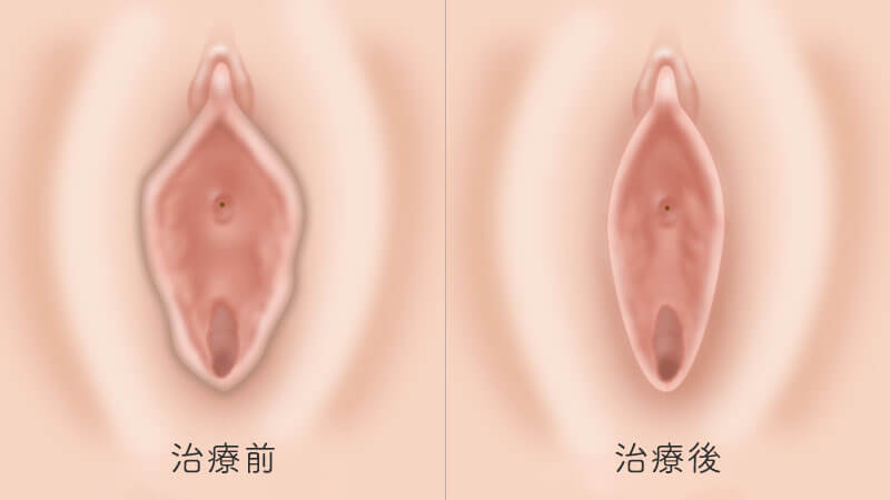 ハイジニーナ、パイパンとは？後悔とやり方 - 夜の保健室