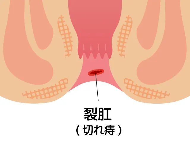 肛門が痛い(肛門・便・尿の症状)から病気を探す｜東京ドクターズ