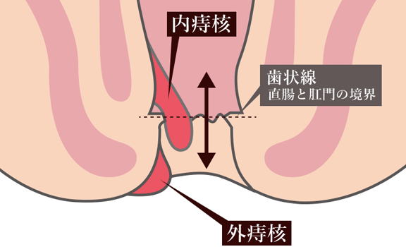 痔の薬はどれがいい？痔に効く外用薬と内服薬の選び方を解説 | お薬専門通販のミナカラ｜オンライン薬局