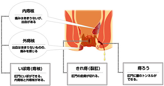 赤ちゃんの痔の治し方】切れ痔・痔ろうのケア。病院は何科？ | kosodate LIFE（子育てライフ）