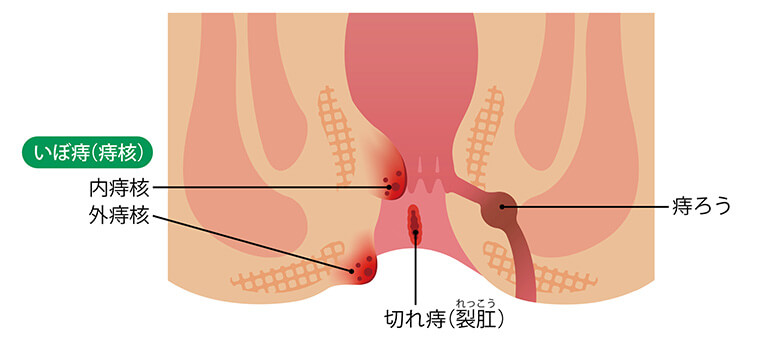 いぼ痔はオロナインで改善する？特徴から見る対策方法について解説 | 漢方生薬研究所