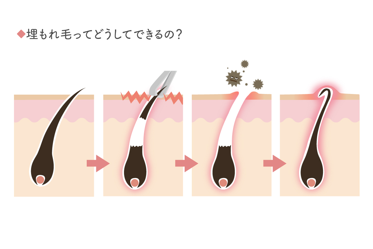 毛抜きでも毛根は死ぬ？やり方と脱毛との関係・痛くない方法は？ | 内科総合クリニック人形町