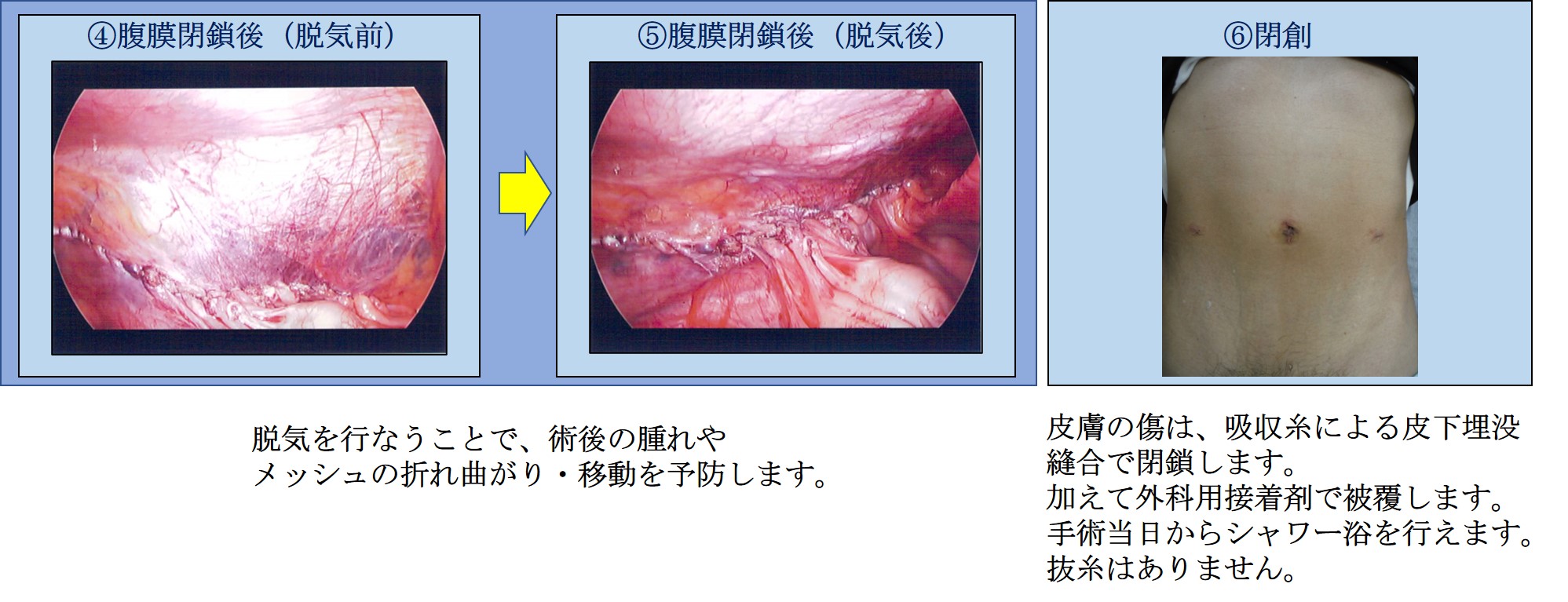 メッシュを使用した鼠径ヘルニア修復手術の鼠径部疼痛 | よこすか女性泌尿器科