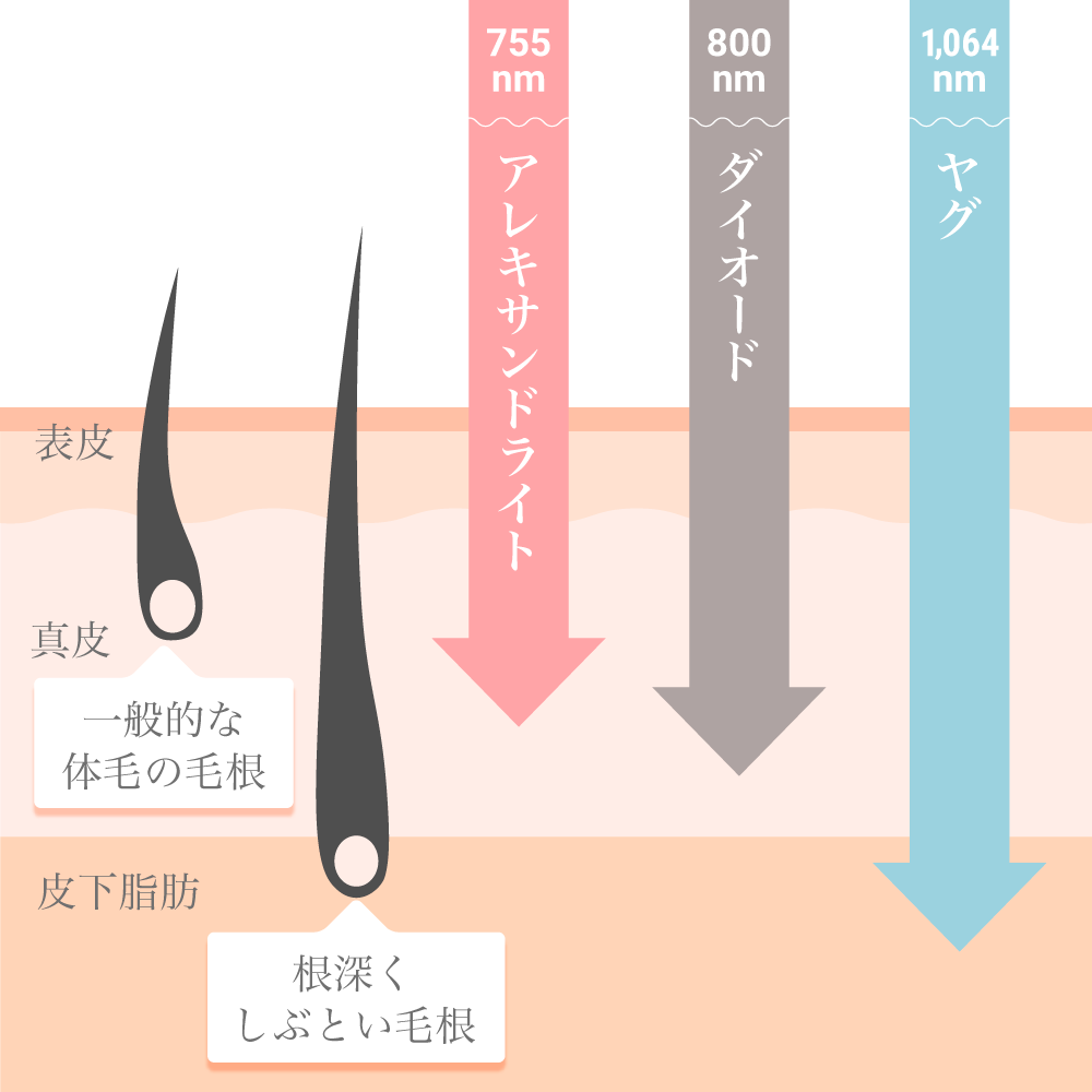 体毛処理でかゆいのはなぜ？原因と対処方法