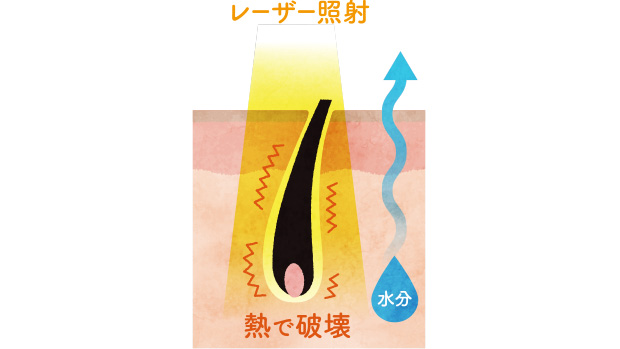 医師監修】VIO脱毛のときのかゆみ、どうしたらいいですか？｜フェミニーナ｜小林製薬