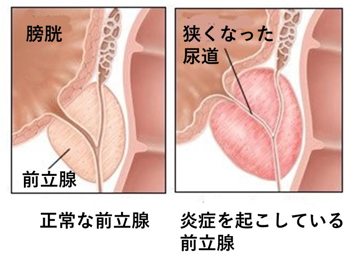 前立腺肥大症と過活動膀胱の手術やその他の治療法【男性向け】 | メディカルノート