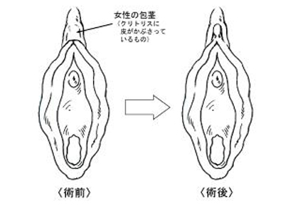 クリトリス包茎 | 婦人科形成 |