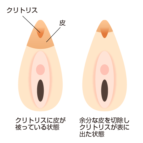 そのクリトリス！放っておくと大変なことに…！包茎で剥けない症例とは？