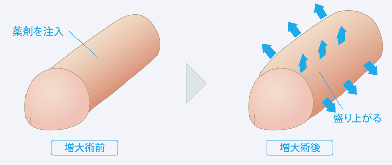 陰茎増大・ペニス増大/仙台中央クリニック/福島・山形