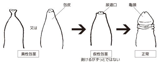 むけない包茎を自分で改善できる方法「むきトレ」とは？ | ネオ形成外科