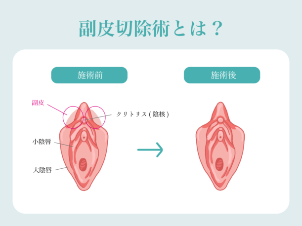 副皮 クリトリス包茎 | 美容外科はベリンダクリニック【新宿院・岡山院】