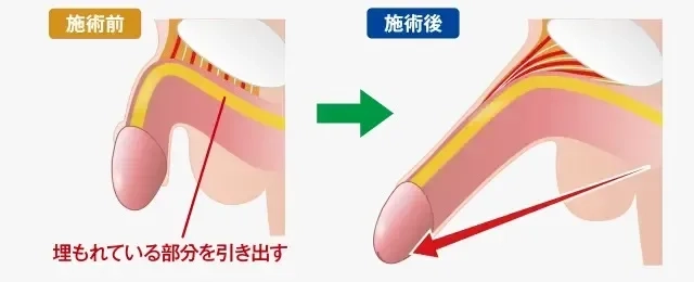 小さいペニスは恥じゃない!日本人の平均サイズとペニスを大きくする方法｜ネット総合病院｜薬のネット通販・個人輸入