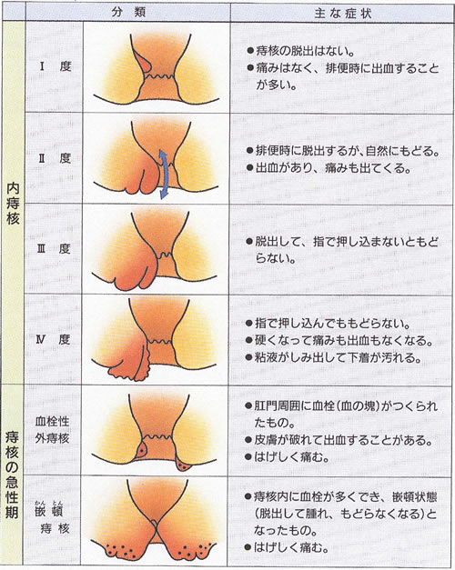 肛門の症状から考える | 内科・肛門科・消化器科・外科 いしもとクリニック