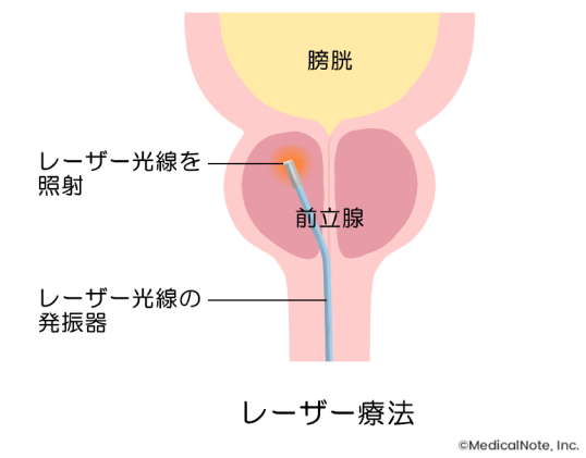 前立腺肥大症と過活動膀胱の手術やその他の治療法【男性向け】 | メディカルノート