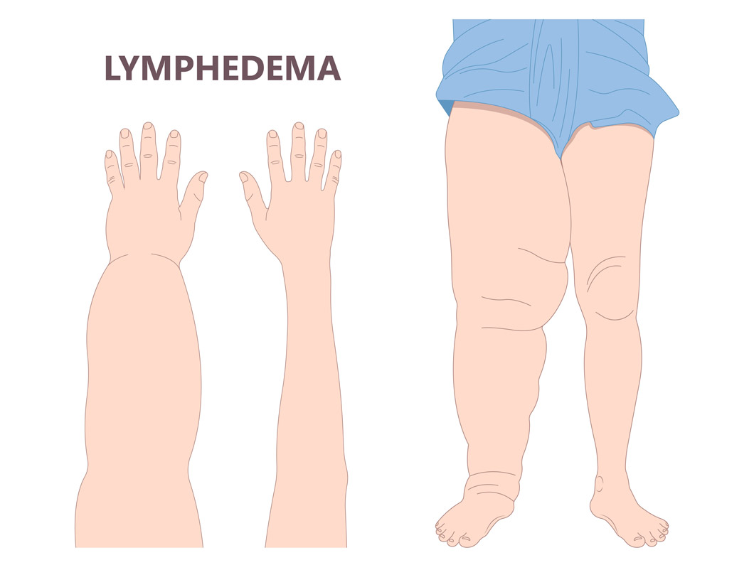 リンパ管炎 | 医師が作る医療情報メディア【medicommi】