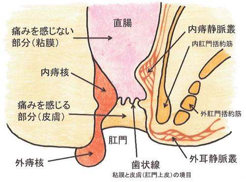 切れ痔(お尻の痛み・血便・便秘)｜鎌倉市・逗子市・葉山町の鎌倉逗子胃腸肛門内視鏡クリニック｜土日検査対応・鎌倉駅から徒歩5分