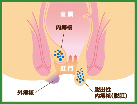 お腹とお尻の診断チャート | 神戸市三宮の大腸内視鏡なら「みつみや大腸肛門クリニック」