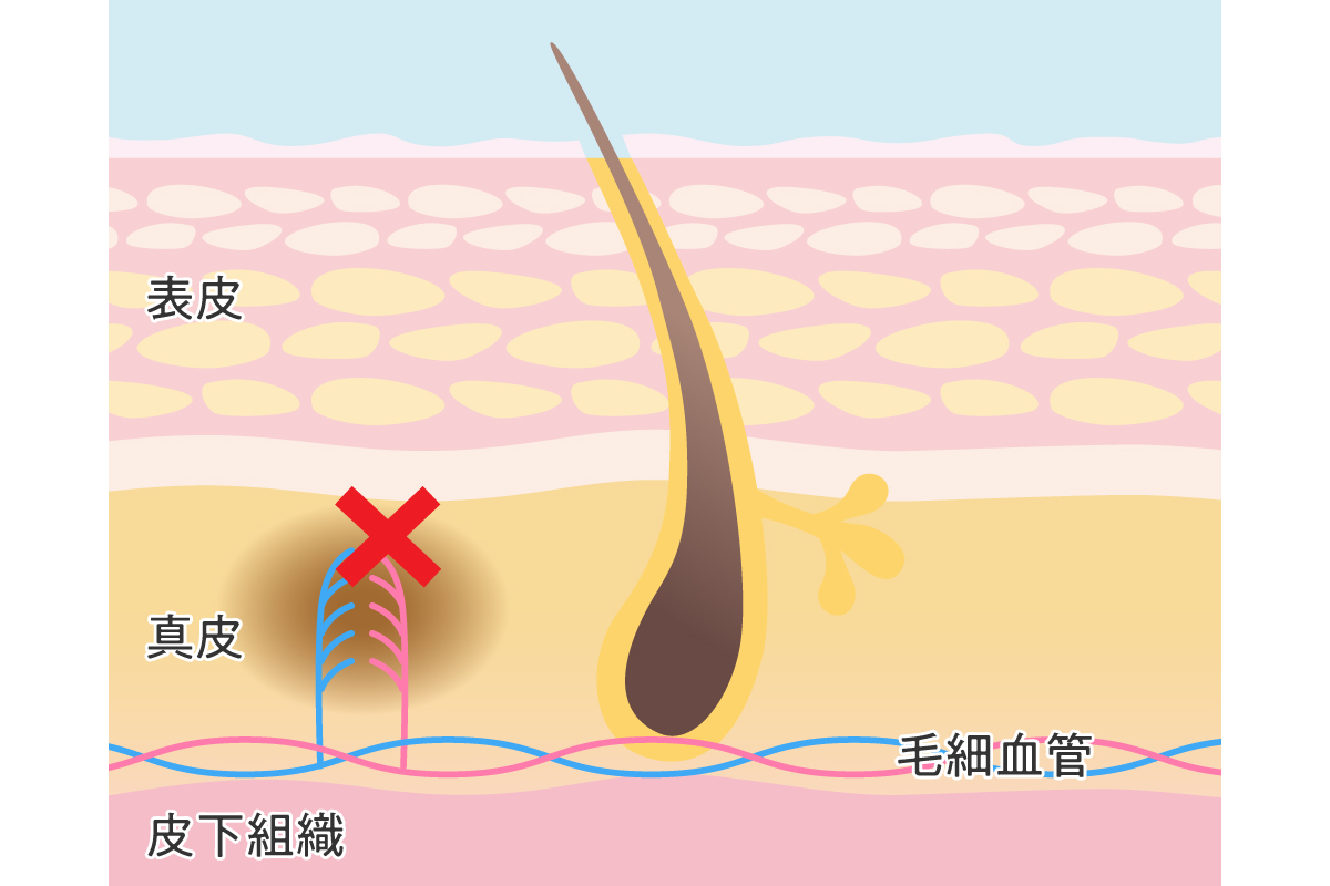 ピンチを切り抜けろ！！消えないキスマークはどうごまかす？ - クラスール