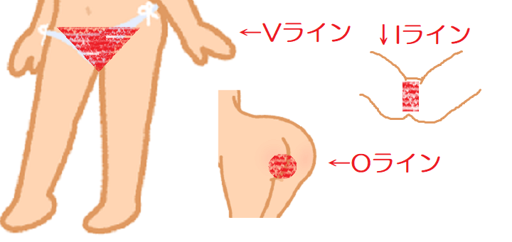 VIO脱毛後にかゆみや痛みを感じる原因は？予防法と対処法を解説｜脱毛・ニキビ治療・ダイエットのイデア美容皮膚科クリニック【柏・船橋・錦糸町】