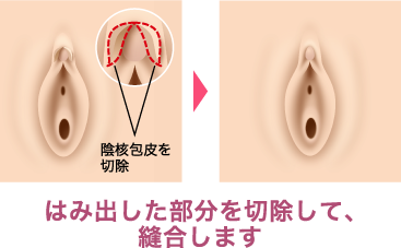 クリトリス包茎切除術 | KAZUKIプライベートクリニック【公式】｜美容外科・形成外科・皮膚科・婦人科