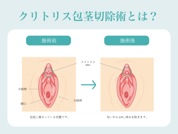 クリトリス包茎 | 婦人科形成なら城本クリニック