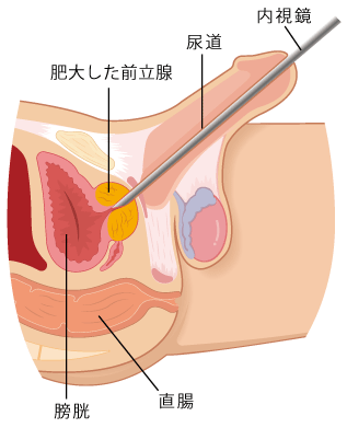 ガイドラインに基づいた前立腺肥大症の正しい知識と治し方 | 同友会メディカルニュース