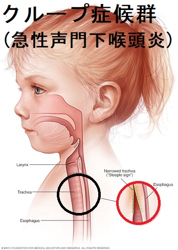 6 第5群： 原因不明あるいは複合的な要因による肺高血圧症