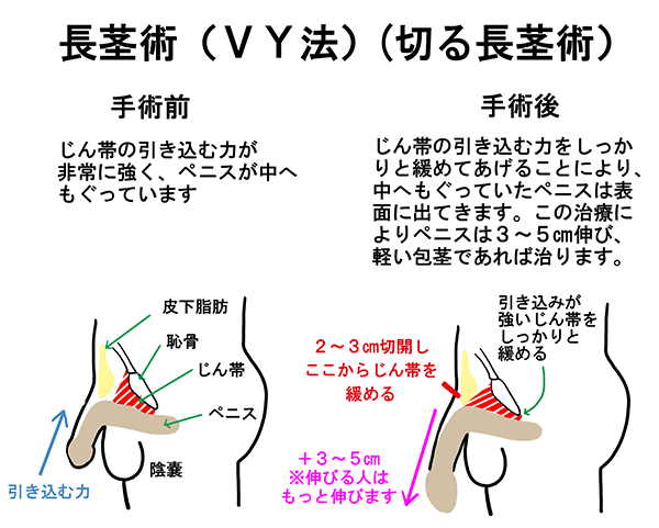 チンペディア】包茎手術やペニス増大手術ができるクリニック検索サイト