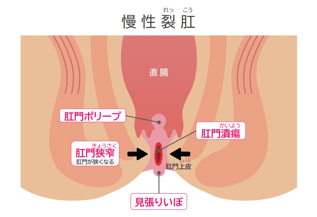 お尻・肛門周りの腫瘍(犬) – 海の公園どうぶつ病院｜横浜市金沢区の犬・猫の専門病院｜夜間・土・日