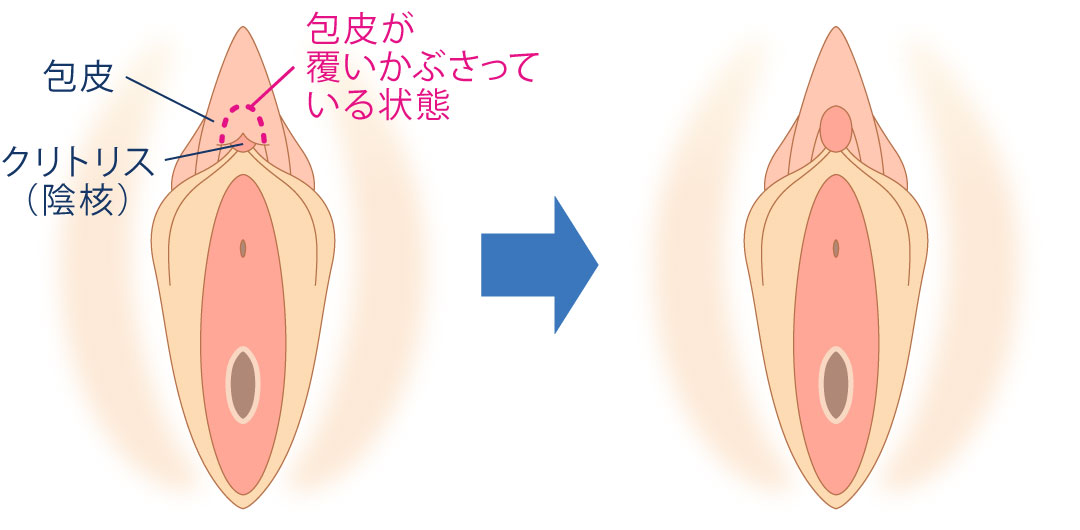 被さっているクリトリスの皮(クリトリス包茎)の治療,サンライズの美容外科