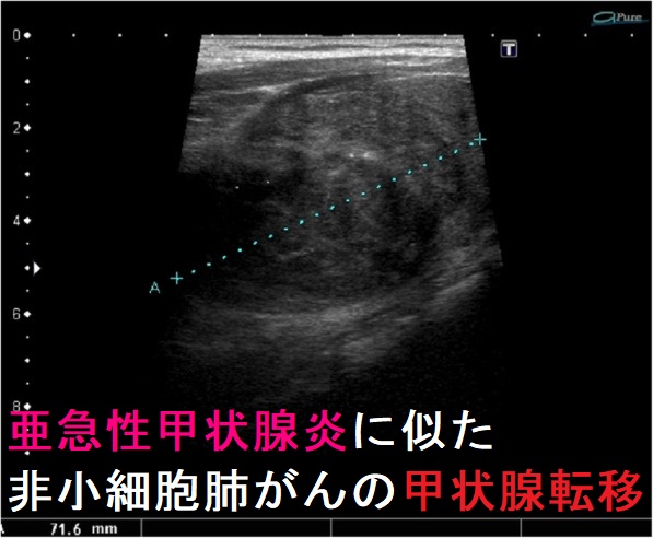 リンパ浮腫の手術概要、方法、効果について | 銀座リプロ外科