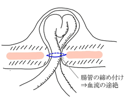 鼠径部（そけいぶ）とは？場所や起こる病気をわかりやすく解説！｜ブログ｜Gi外科クリニック