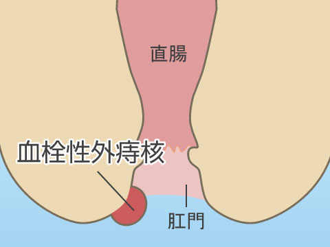 肛門周囲膿瘍・痔ろう | 岡山市 肛門科【おくむら大腸肛門クリニック】麻酔下大腸内視鏡