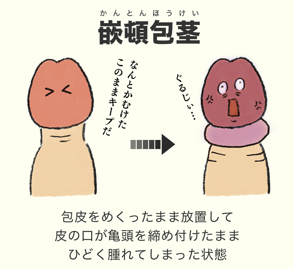 年齢別】10代20代の包茎の正しい剥き方はこれ！ - アトムクリニック -