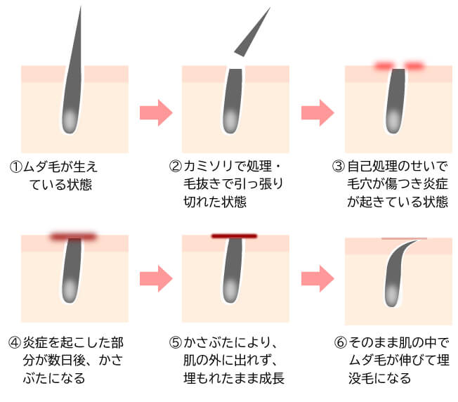 永久脱毛とは？本当に生えてこない？後悔した人の体験談やデメリットも紹介