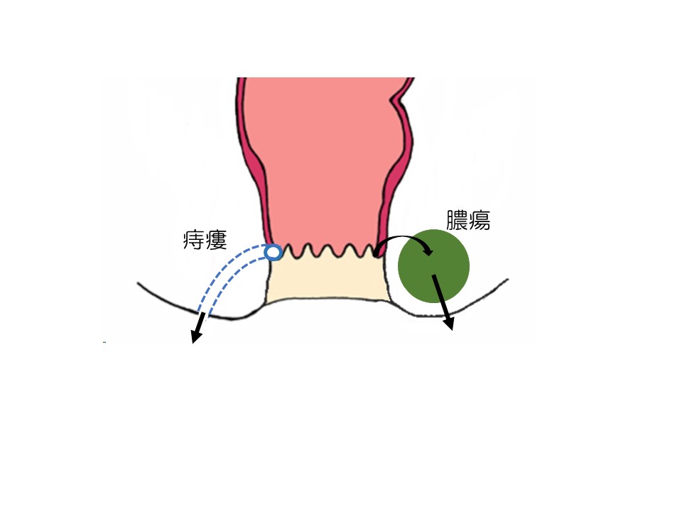 直腸脱はどんな病気｜市民のみなさまへ｜日本大腸肛門病学会