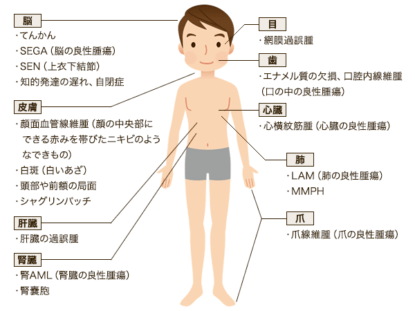 非特異性多発性小腸潰瘍症 画像診断アトラス