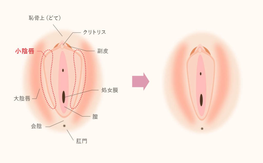 クリトリス包茎 - 美容外科｜船橋中央クリニック&青山セレスクリニック