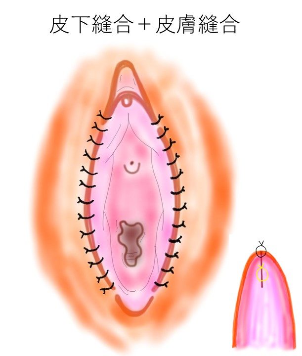 クリトリスの大きさに悩んでいます。 自慰行為の回数の多さも原因だと 思うんですが我慢する事は出来ません… | Peing