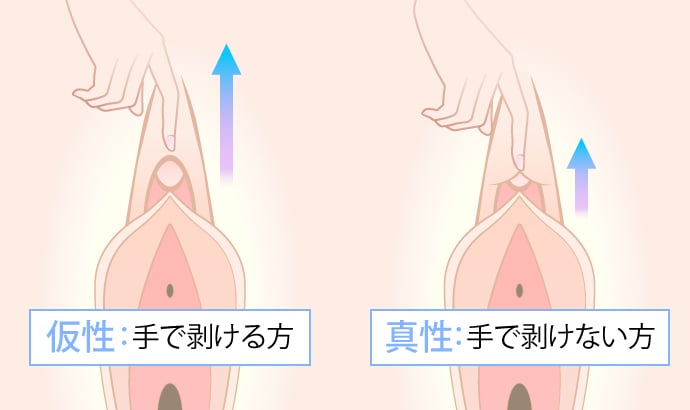 女性の包茎とは？クリトリス包茎における一般的な悩みと対処法 - アトムクリニック -