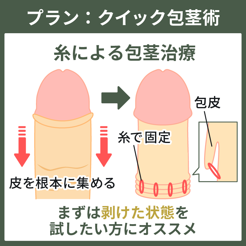 包茎が心配です。むく？むかない？〈性教育10の悩みに答えます⑦〉 - 東京すくすく