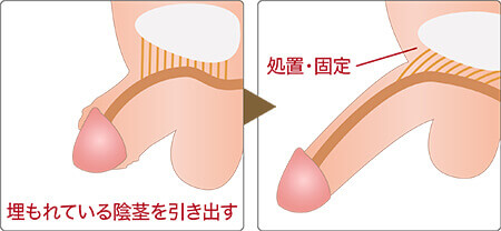 ペニスを太くしたい！勃起力向上ポイントや安全に太くできる方法を解説 | 包茎手術のノーストクリニック【公式】