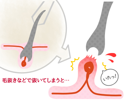 毛抜きで毛を抜き続けると毛根が死んで脱毛効果がある？脱毛の嘘と本当 ｜ エピステ